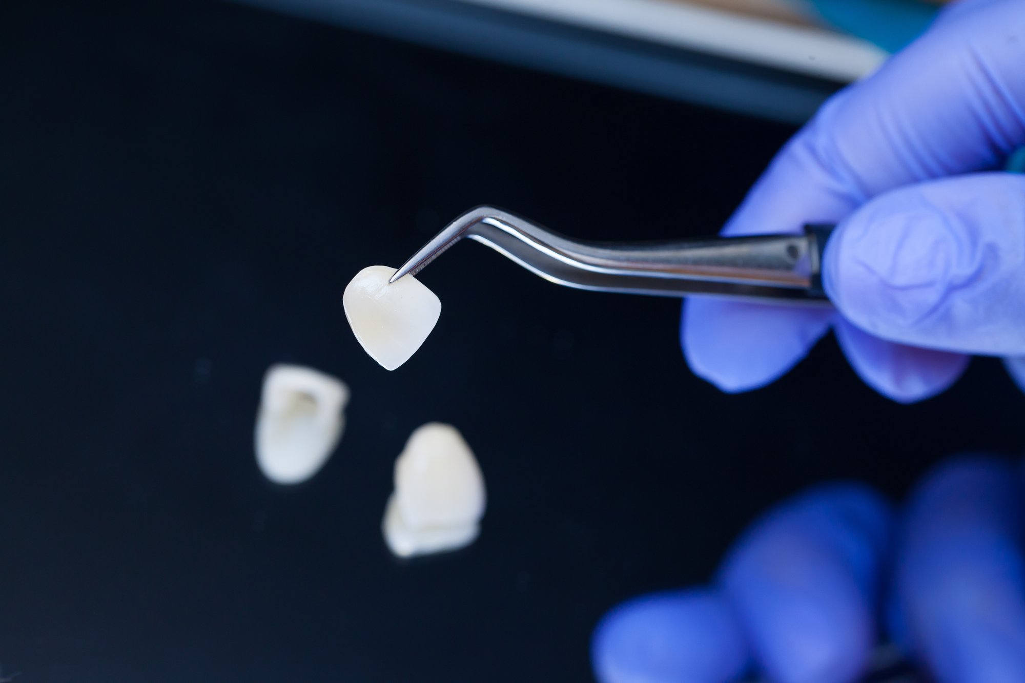 Top 5 Habits That Keep Veneers Looking Flawless